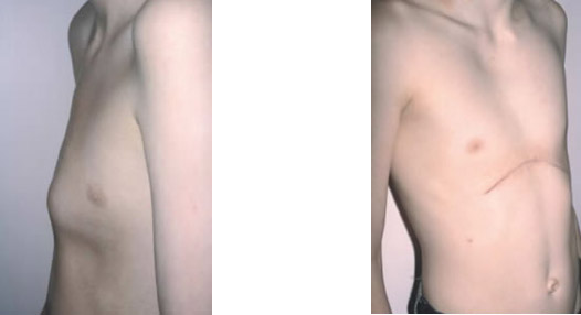 correcao cirurgica deformidade toracica6