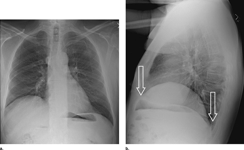 eventracao diafragmatica2