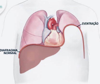 eventracao diafragmatica3