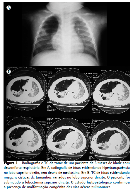 malformacao congenita pulmao