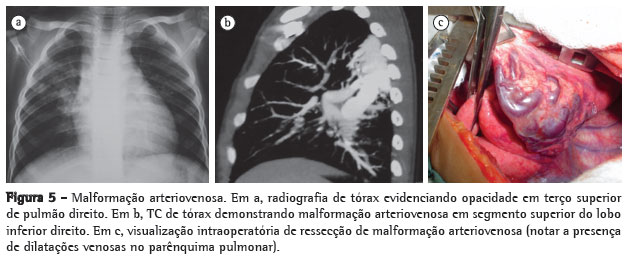 malformacao congenita pulmao