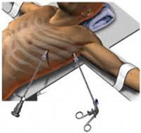 simpatectomia toracica