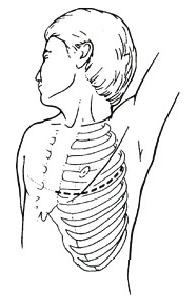 toracotomia antero lateral