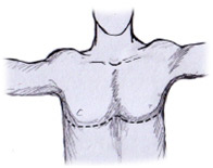 toracotomia transversa