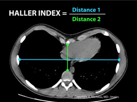 deformidades congenitas parede toracica2