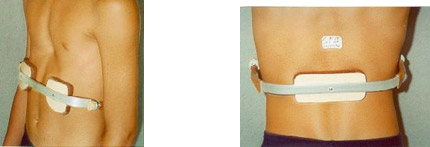 deformidades congenitas parede toracica3