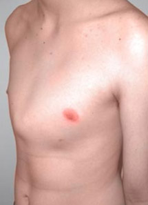 deformidades congenitas parede toracica5