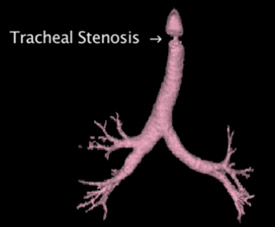 estenose traqueia2