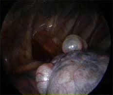 pneumotorax espontaneo2