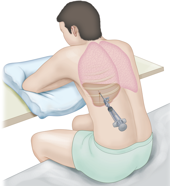 toracocentese20221001