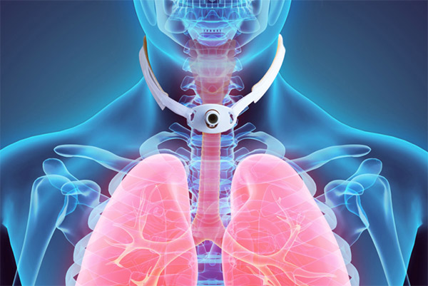 traqueostomia20220413