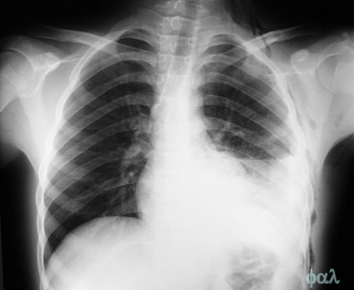 trauma toracico20220427