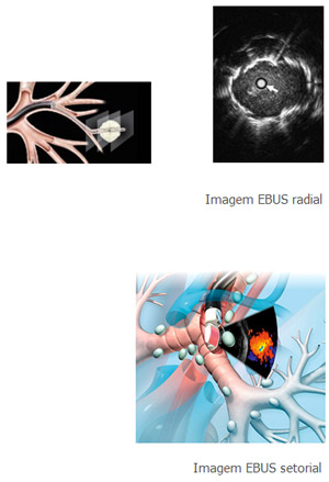 ultrassonografia endobronquica20220126