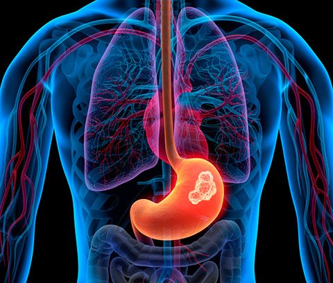 cirurgia toracica em casos de tumores neuroendocrinos20241113