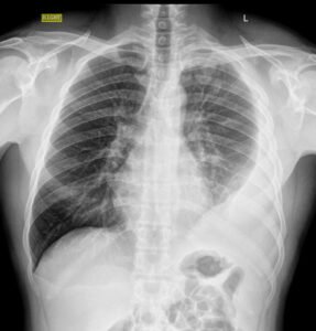 radiografia Derrame Pleural