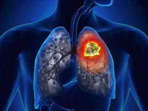 screening de cancer de pulmao