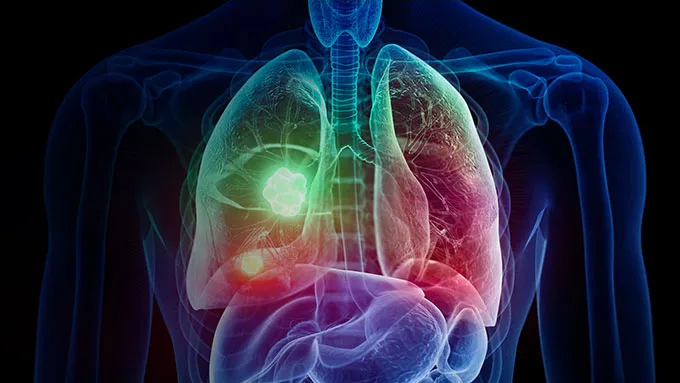 screening pulmao