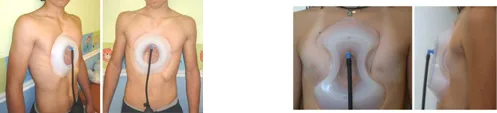 tratamento para Pectus Excavatum vacuum bell