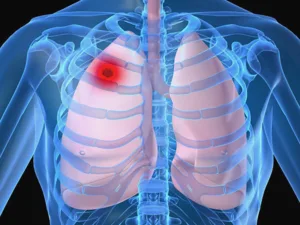 tumores pulmonares benignos