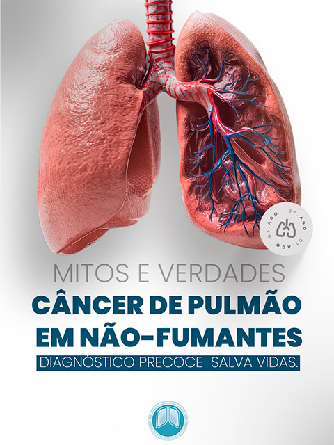 Câncer de pulmão em não fumantes: mitos e realidades