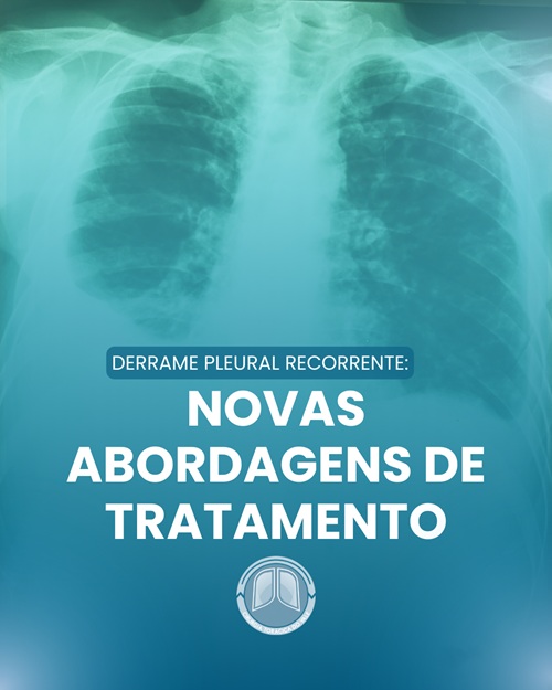 Derrame pleural recorrente: novas abordagens de tratamento