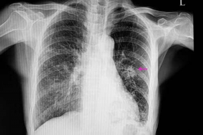 Nódulo pulmonar: o que significa esse achado no exame?