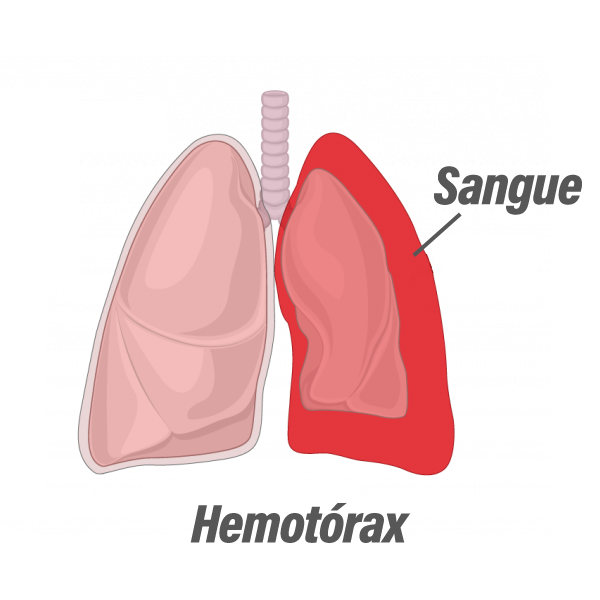 Hemotórax