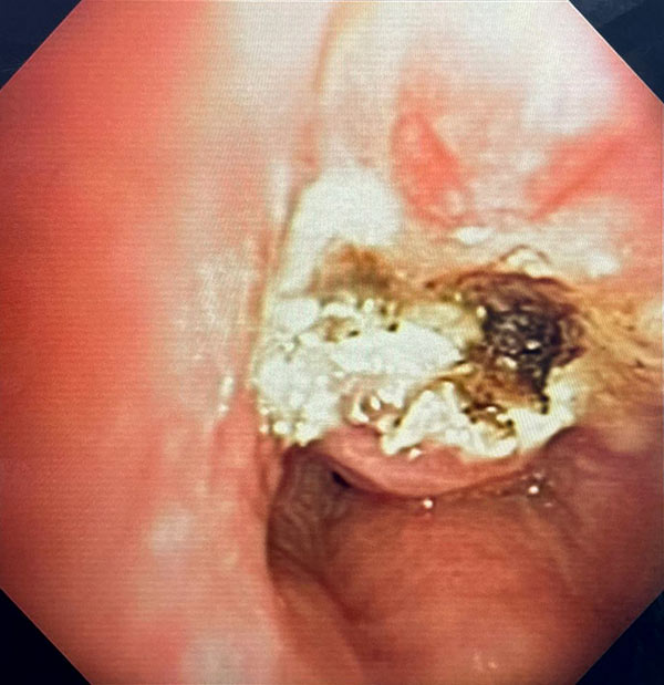 Ressecção por laser de estenose traqueal