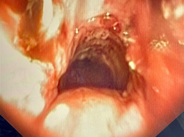 Luz traqueal totalmente aberta. 